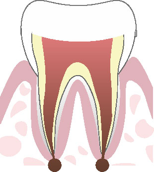 根管治療の流れ