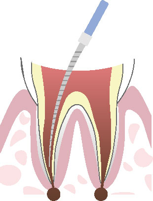根管治療の流れ