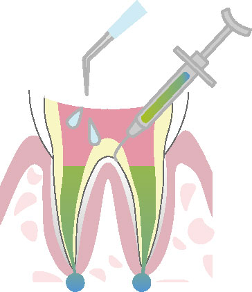 根管治療の流れ