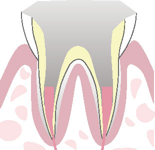 根管治療の流れ