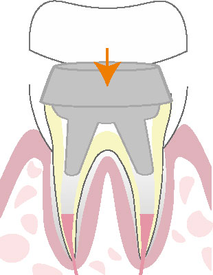 根管治療の流れ
