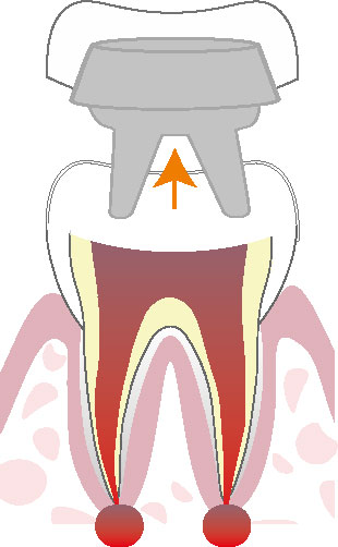 根管治療の流れ