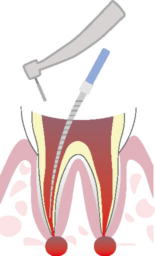 根管治療の流れ