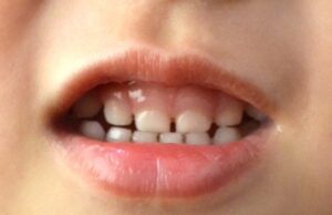 子ども　歯並び　受け口