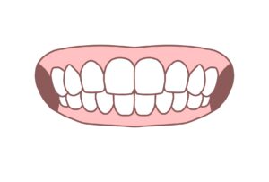 正常な歯並び　受け口