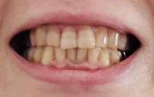 ホワイトニング