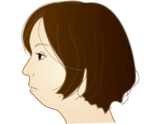 口呼吸　アデノイド顔貌