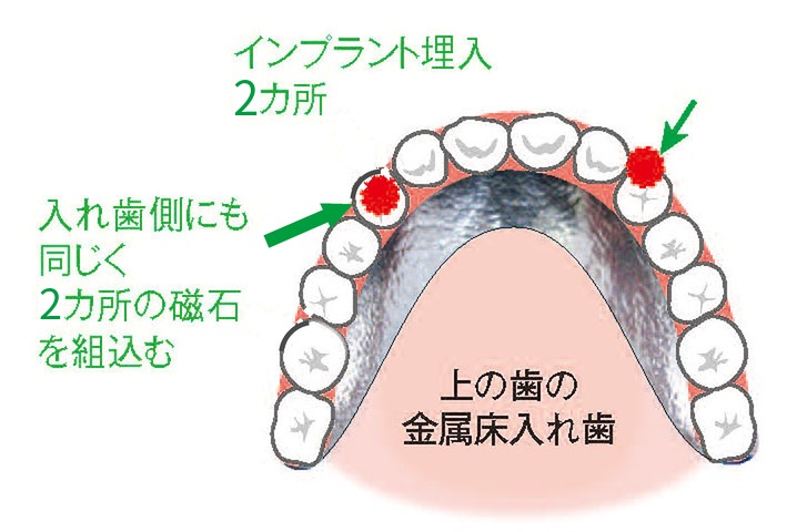 インプラント治療