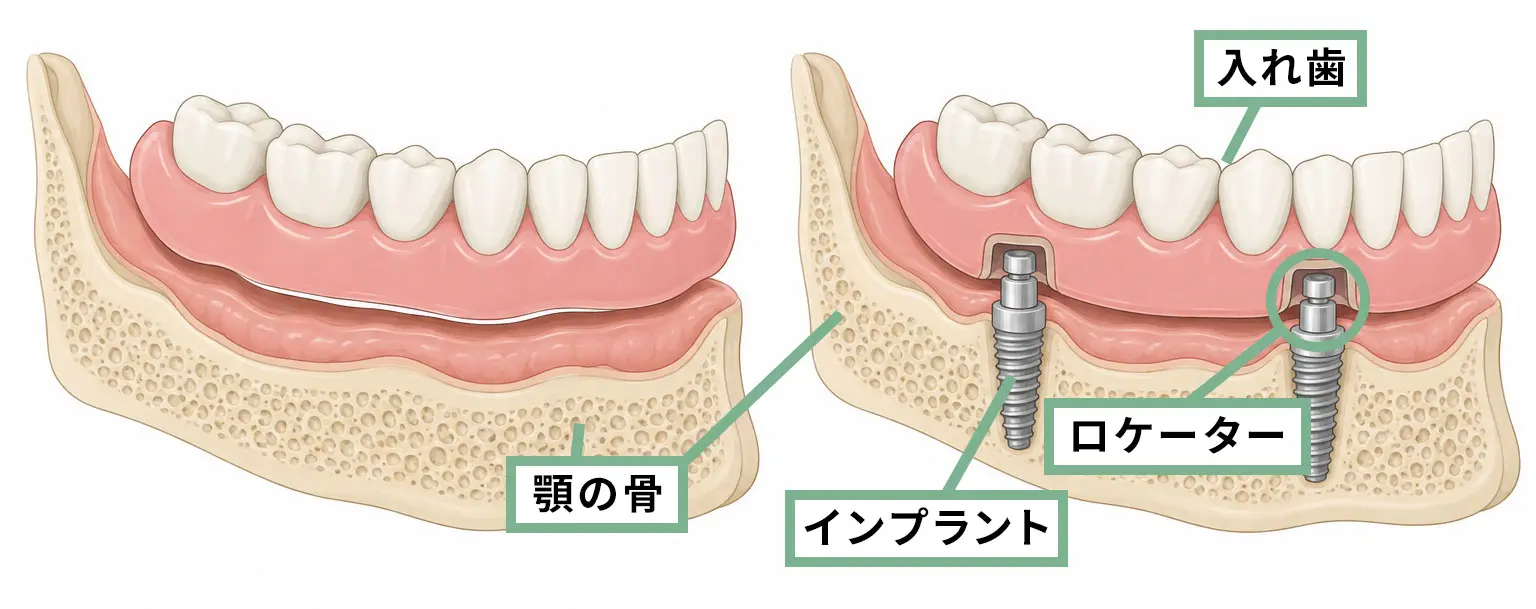 インプラントオーバーデンチャー（IOD）